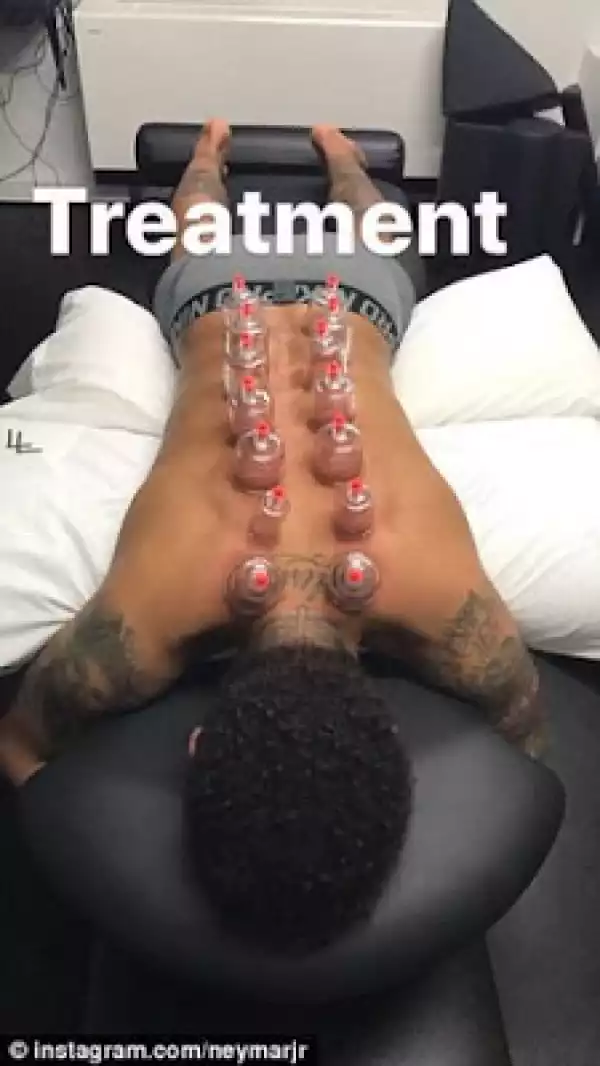 Footballer Neymar Undergoes Fire Cupping Therapy To Treat Injury (Photos)